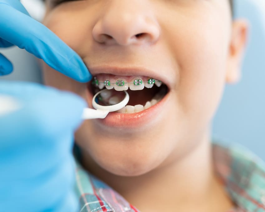 Orthodontic Treatment with Braces
